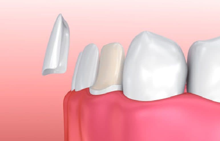 How to Fix a Chipped or Broken Tooth - Your Treatment Options