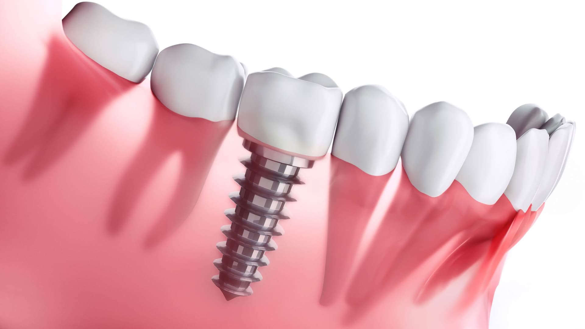 Dental Implants vs Dentures vs Bridges - Which Is Right for You?