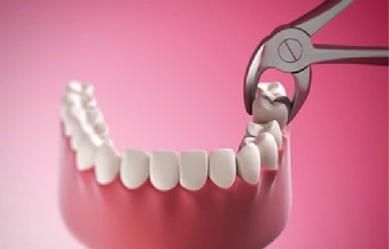 Root Canal vs Tooth Extraction - Pros and Cons