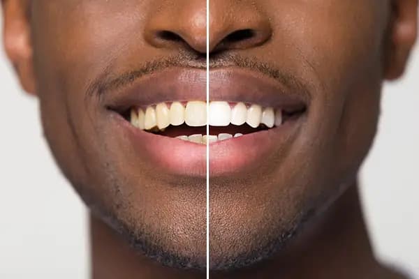 How to Treat Sensitive Teeth - Causes and Effective Remedies