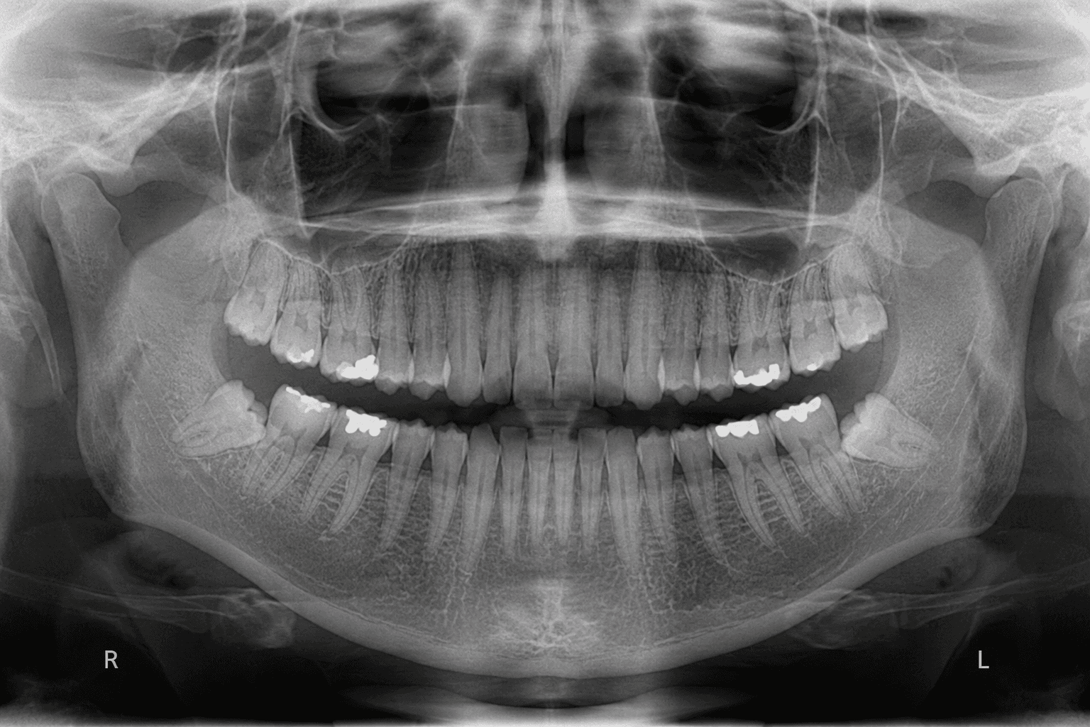 Dental X-Ray